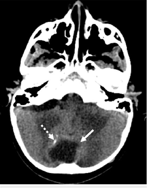 posterior fossa cystic mass.